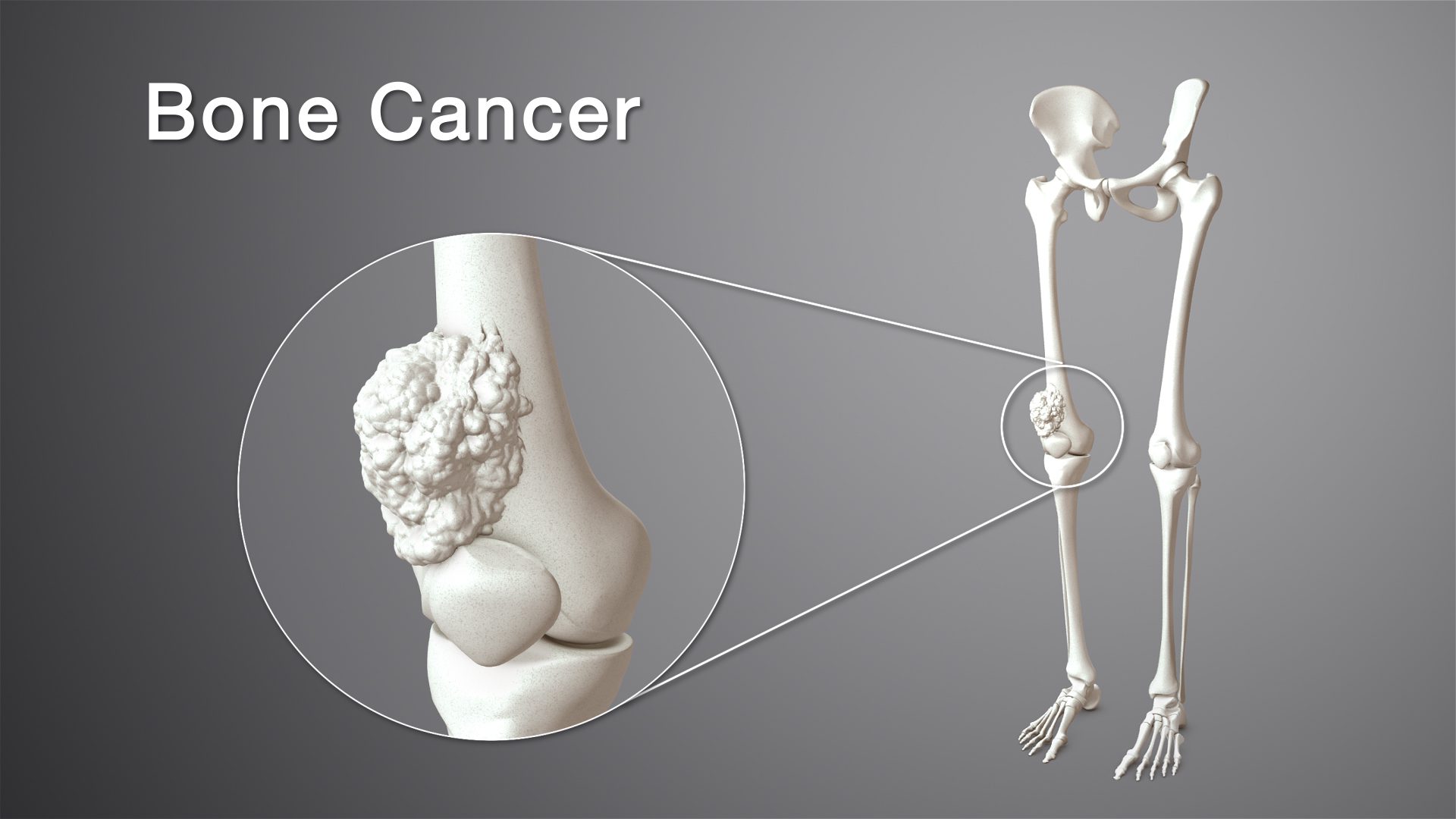 Tanda dan Gejala Kanker tulang